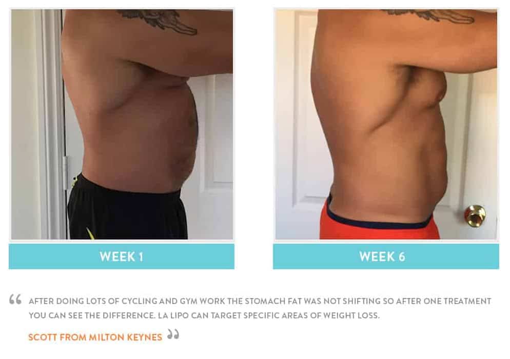 Before & After Stomach Fat Cambridgeshire