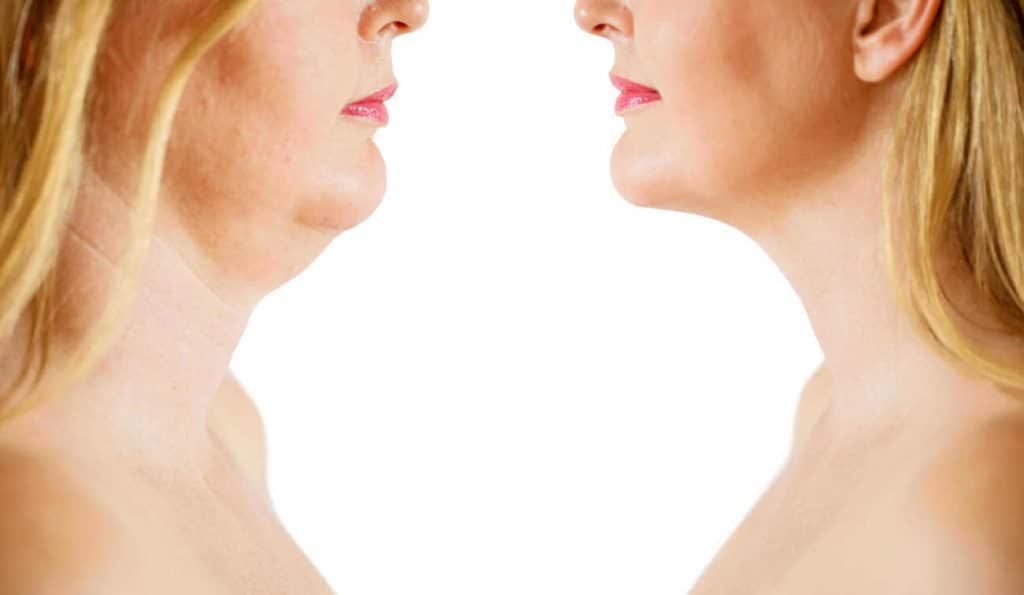 Double Chin treatment Cambridgeshire before and after results