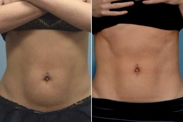body sculpting FAQs Cambridgeshire