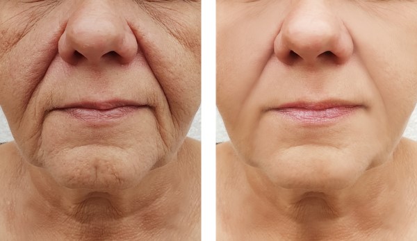 Learn more about Morpheus8 Treatment Cambridgeshire today!
