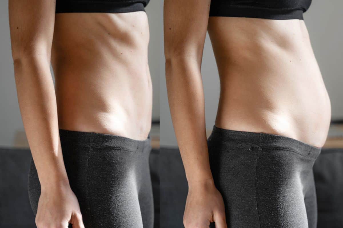 How long does diastasis recti take to improve Cambridgeshire?