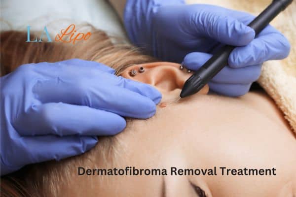 Dermatofibroma Removal Treatment Cambridgeshire