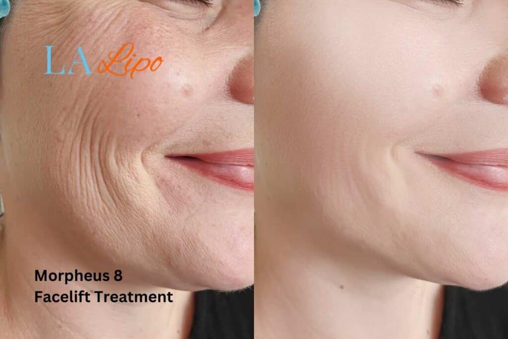 Morpheus8 Treatment Cambridgeshire for flawless skin! Call us today!