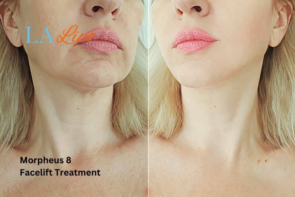 Turn back time with Morpheus8 Treatment Cambridgeshire