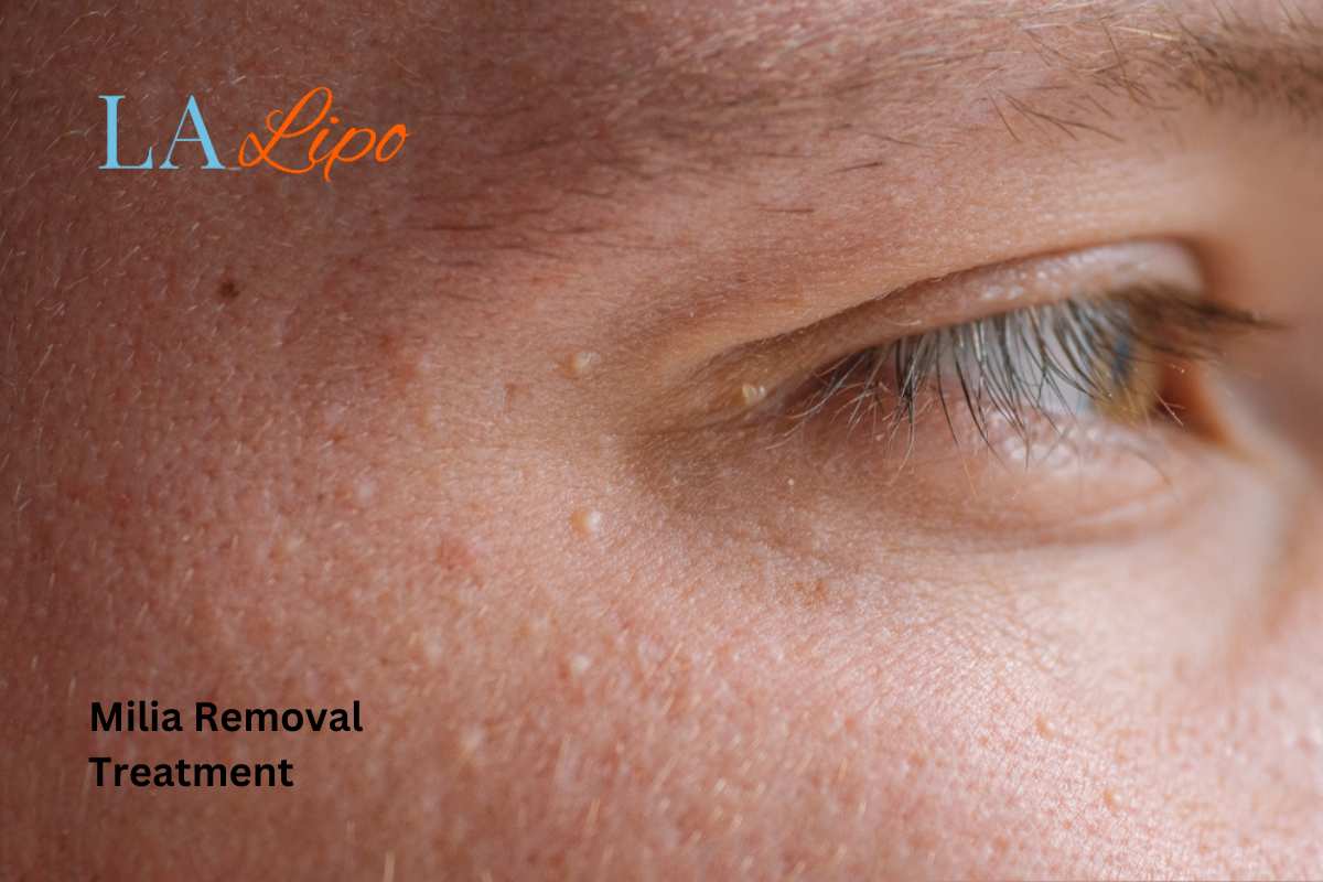Cryopen Milia Removal: Is It the Easiest and Safest Option Cambridgeshire?