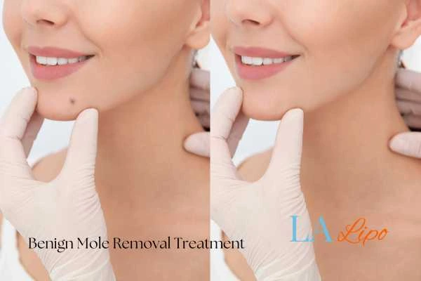 Before-and-after results following benign mole-removal treatment Cambridgeshire
