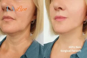 hi-fu for wrinkles Cambridgeshire before and after results