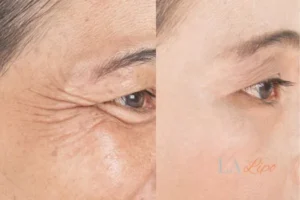 Before and after results of woman - HI-fu wrinkles reduction treatment Cambridgeshire