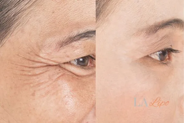 Before and after results of woman - HI-fu wrinkles reduction treatment Cambridgeshire