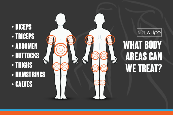 Graphic to show areas you can have LA-EMS Body Sculpting Cambridgeshire treatment.