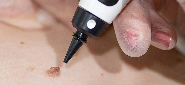 skin tag removal using cryopen Cambridgeshire