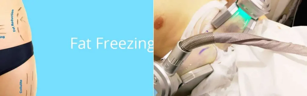Fat freezing Cambridgeshire on multiple areas of the body