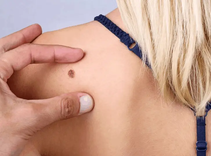 woman having mole removal Cambridgeshire consultation before treatment.