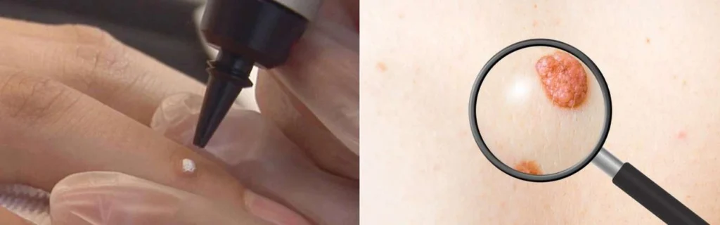CryoPen practitioner Cambridgeshire assessing a benign mole before treatment