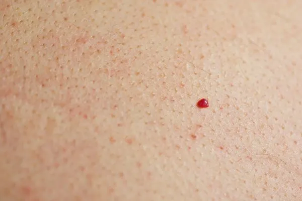 close up of a cherry angioma Cambridgeshire