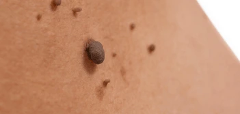 image of a skin tag Cambridgeshire