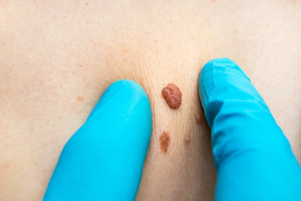 Consultant examining a skin tag Cambridgeshire