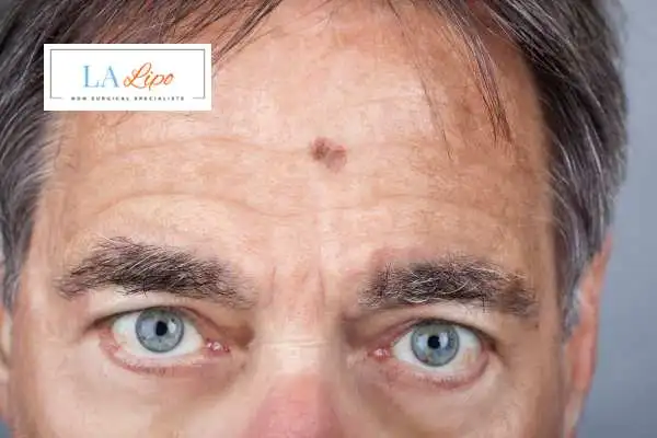 Solar Lentigo Removal Cambridgeshire image of man with mark on his forehead