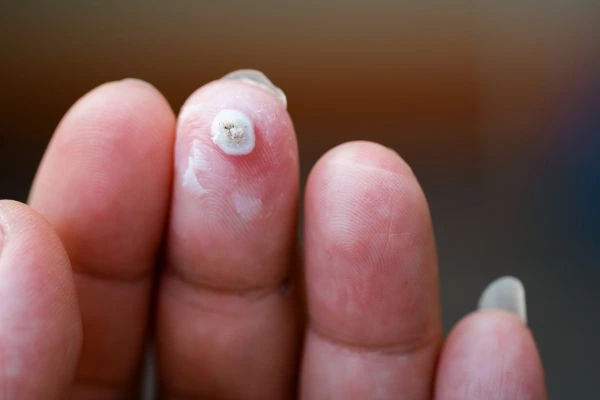 wart on person finger - cryotherapy to treat from LA LIPO Cambridgeshire
