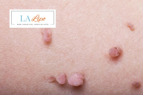 Does cryopen skin tag removal Cambridgeshire hurt? Find out now call our team today!