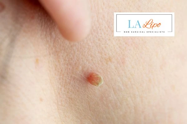 Book skin tag removal Cambridgeshire today speak to our team now!