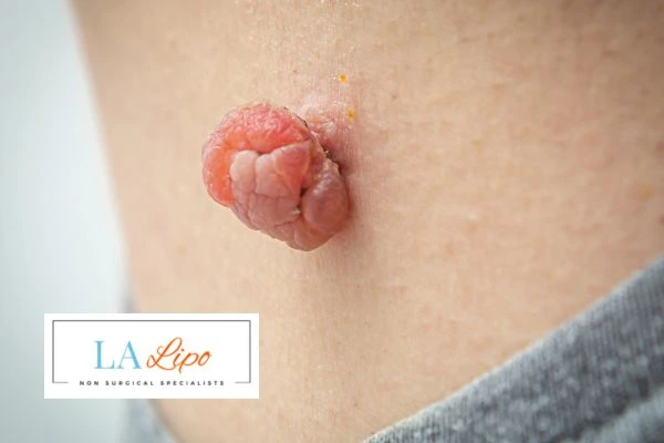 Interested in skin tag removal Cambridgeshire? Concerned about the pain? Find out more today!