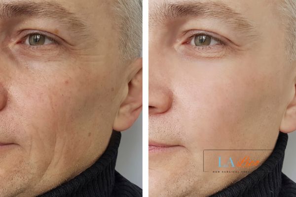 See the amazing results of Morpheus8 Treatment Cambridgeshire!