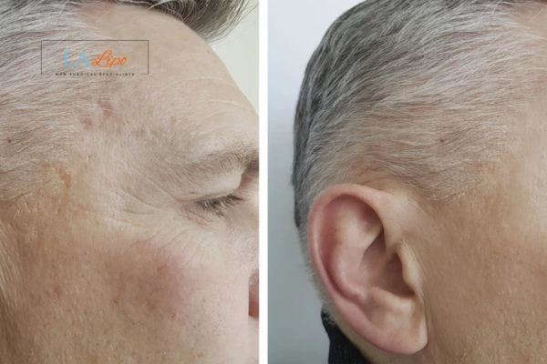 Mens Before & After Morpheus 8 Results Cambridgeshire
