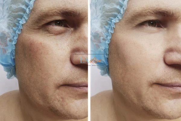 Before and after Morpheus 8 Results Cambridgeshire