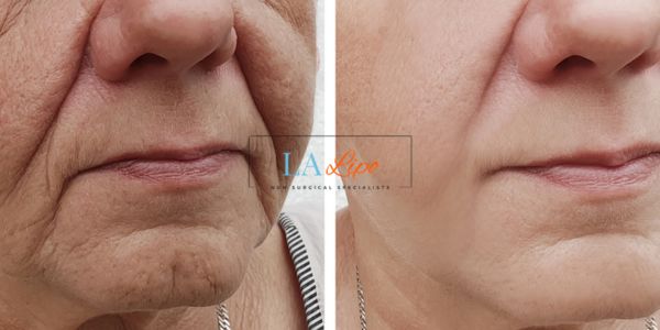 Older lady deeper wrinkle reduction - LA LIPO Morpheus 8 Results Cambridgeshire
