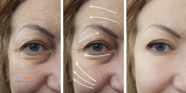 Amazing eye lift Morpheus 8 results Cambridgeshire