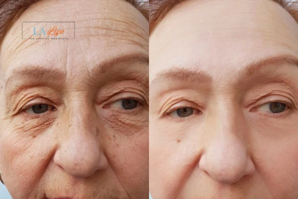 The powerful benefits of Morpheus8 Treatment Cambridgeshire - Call Our team today!