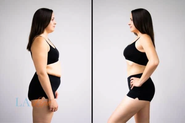 Picture of womans before and after using LA-EMS body sculpting to improve her core strength Cambridgeshire