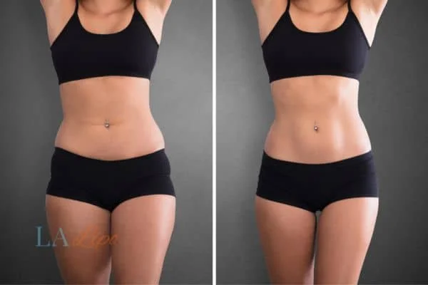before and after results of non-surgical treatment to help a woman's body image and mental health Cambridgeshire