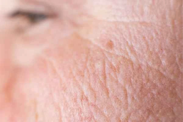 close up picture of a woman's face showing an age spot Cambridgeshire