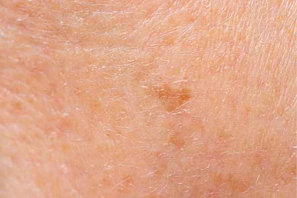 close up picture of age spots Cambridgeshire