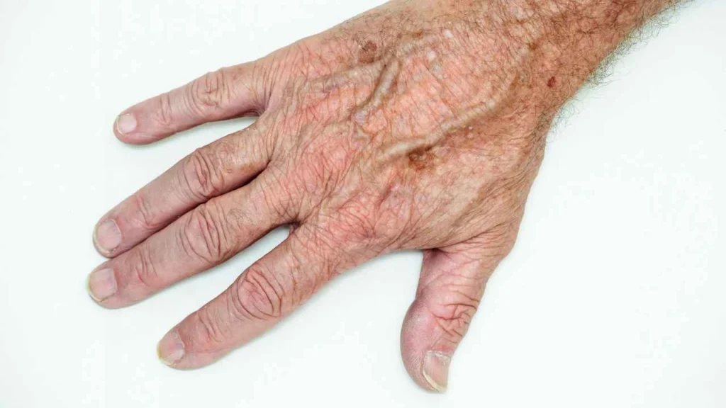 Male hand showing age spot Cambridgeshire