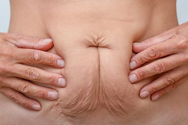 Should I Combine Diastasis Recti Treatment with Body Contouring for Better Results Cambridgeshire?