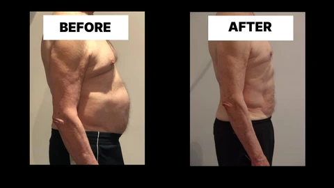 What Symptoms Can Diastasis Recti Cause in Men? Weak Core, Back Pain and Poor Posture Cambridgeshire